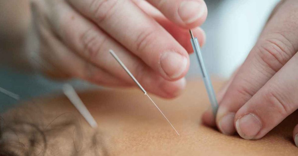 Acupuncture How it Works And Why It's Great MBS Fitness