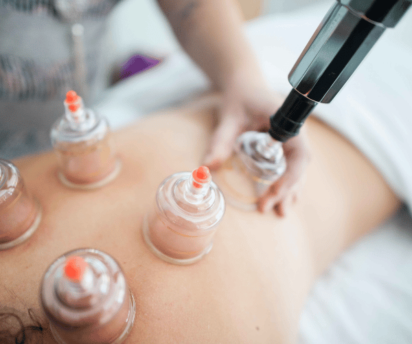 cupping therapy session at vaughan location